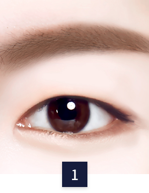 수술 방법