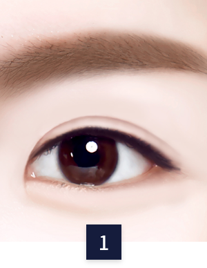수술 방법