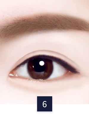 수술 방법