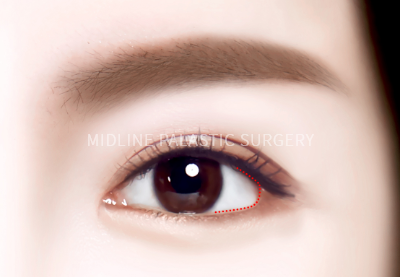 eye_restoration-title1.png eye_restoration-title1.png