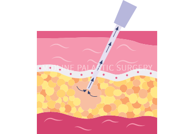 fat-graft_title1.png fat-graft_title1.png