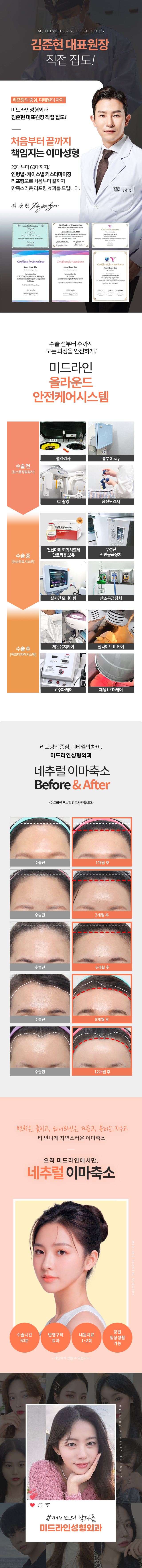 forehead-reduction_mo_2.jpg