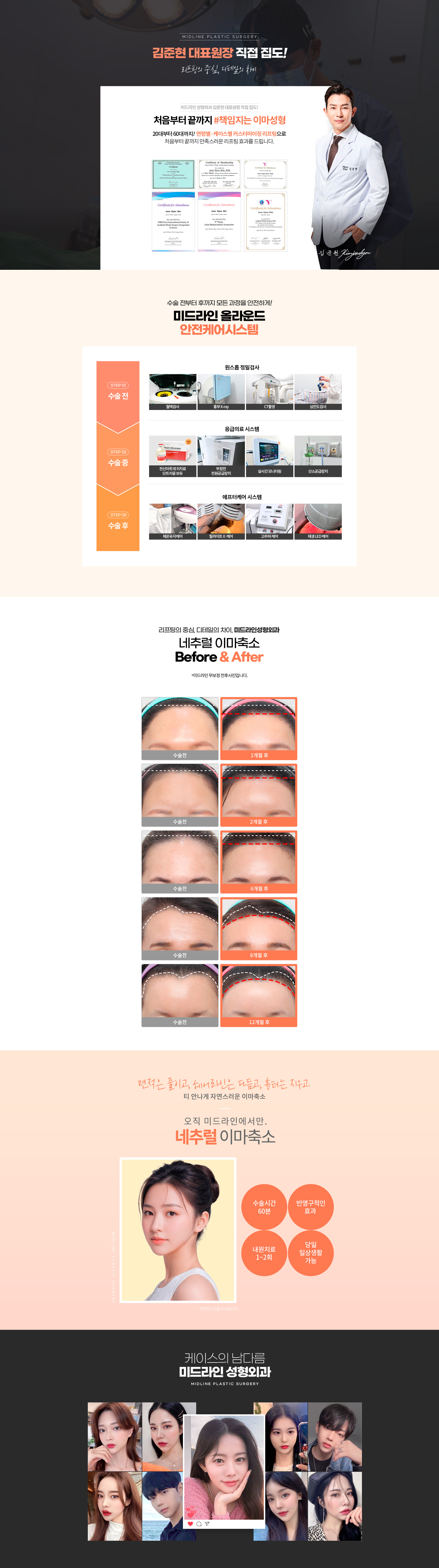 forehead-reduction_pc_2.jpg