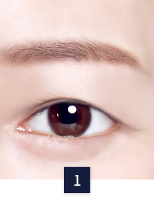 수술 방법