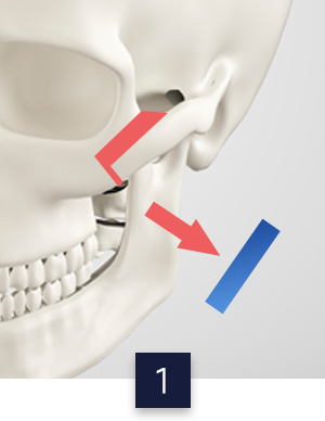 광대수술방법_이미지확대홈페이지컷1.png 광대수술방법_이미지확대홈페이지컷1.png