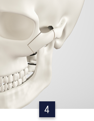 광대수술방법_이미지확대홈페이지컷4.png 광대수술방법_이미지확대홈페이지컷4.png